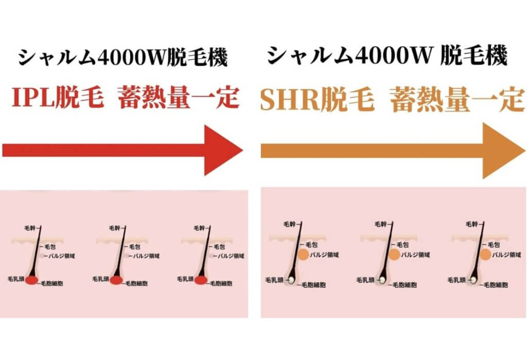 IPL SHRシャルム脱毛機 出力一定